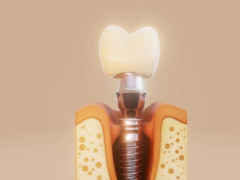 Dentalimplant